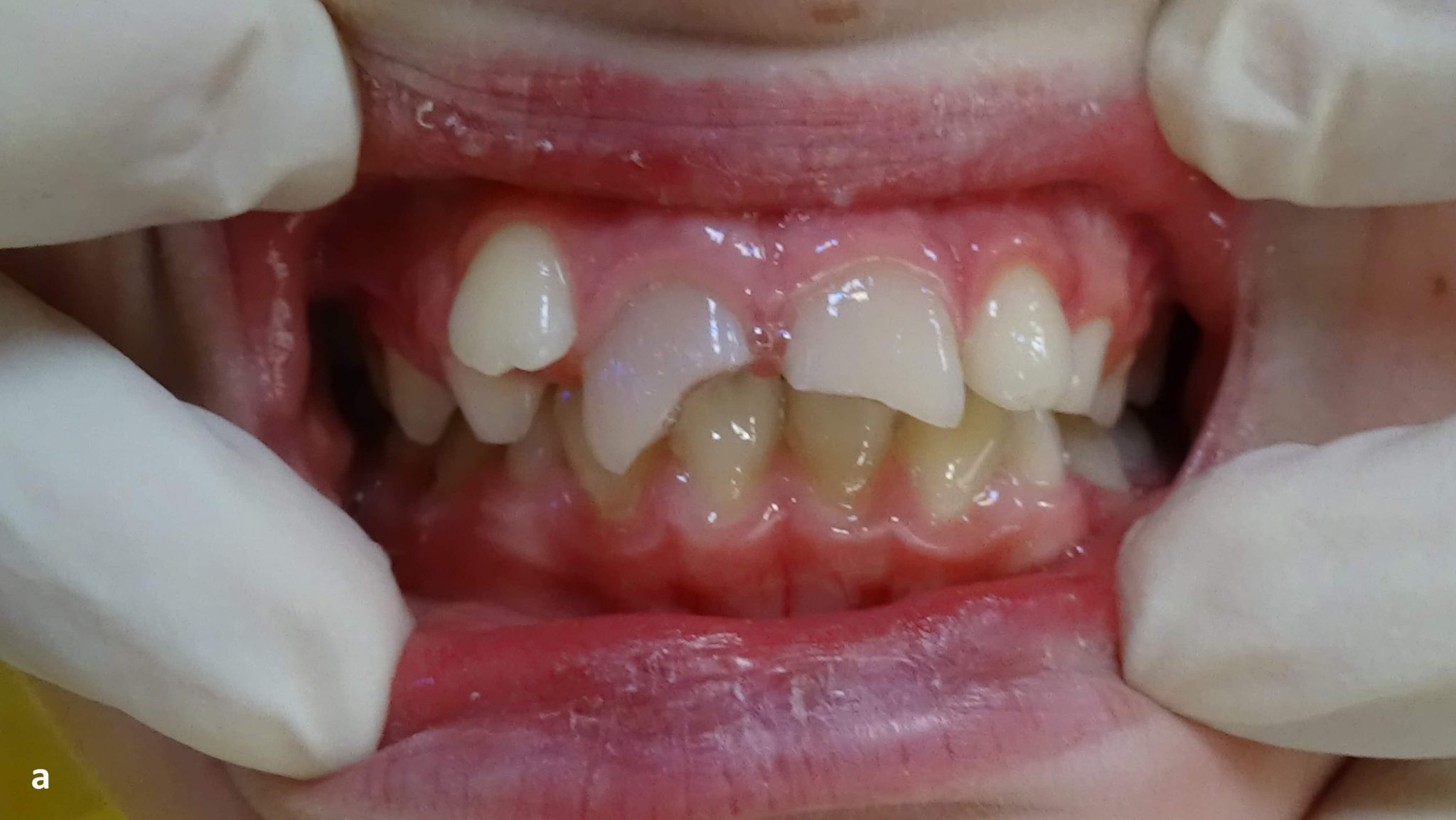 Increased overjet early versus late management. Literature review and